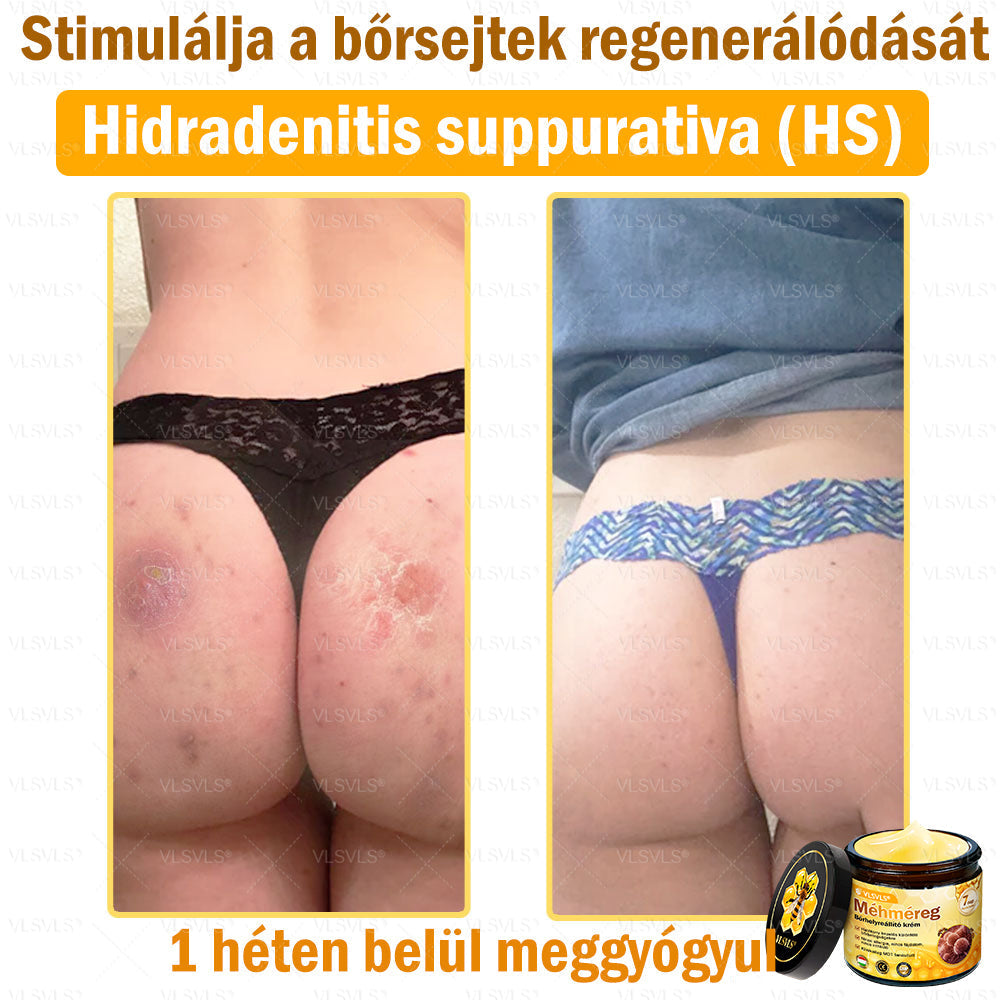 ✨✨✨💪VLSVLS® Méhméreg Bőrhelyreállító Krém (👨‍⚕‍CE jóváhagyott)👍✅