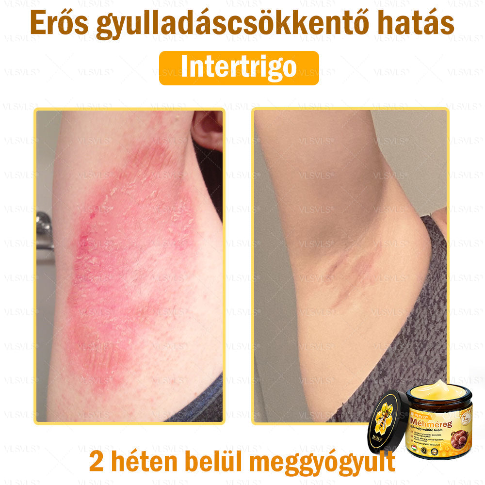 ✨✨✨💪VLSVLS® Méhméreg Bőrhelyreállító Krém (👨‍⚕‍CE jóváhagyott)👍✅