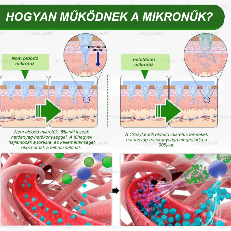 ✨✨│Hivatalos webáruház│🌿 CrazyLeaf® SMGT-GLP-1 Nano Mikrotűs Tapasz 👉Természetes segítség túlsúly, fáradtság, bőr- és ízületi problémák ellen.ermészetes segítség túlsúly, fáradtság, bőr- és ízületi problémák ellen.