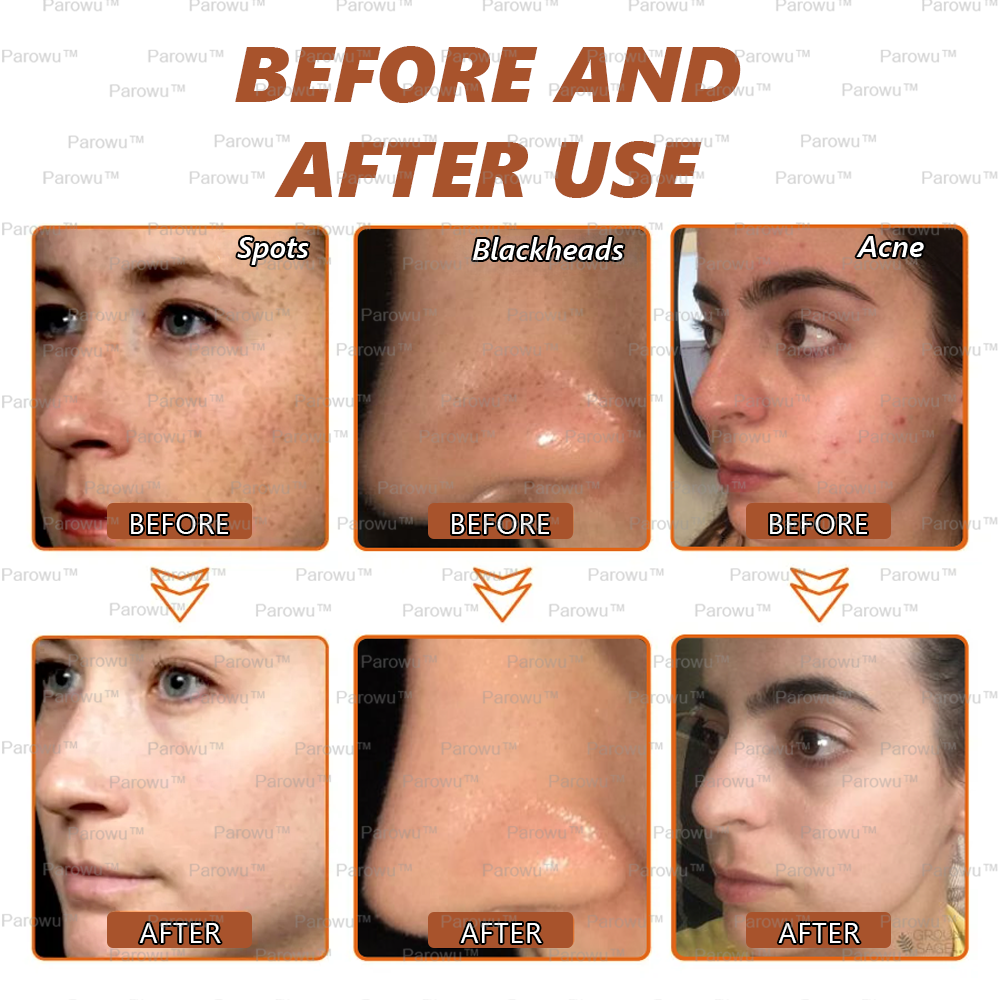 🏵️🏵️ Parowu™ Whitening and Spot-Removing Face Mask Suitable for face and body – 👩‍⚕️ Natural ingredients permanently remove age spots, freckles, sun spots, and liver spots.