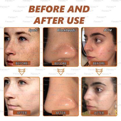 🏵️🏵️ Parowu™ Whitening and Spot-Removing Face Mask Suitable for face and body – 👩‍⚕️ Natural ingredients permanently remove age spots, freckles, sun spots, and liver spots.