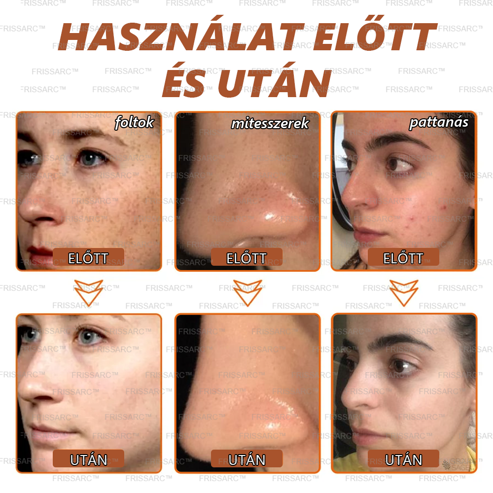 (40%-60% kedvezmény élvezete) 𝐅𝐑𝐈𝐒𝐒𝐀𝐑𝐂™ Fehérítő És Folteltávolító Arcmaszk - Természetes összetevők tartósan eltüntetik a foltokat, szeplőket és napfoltokat.