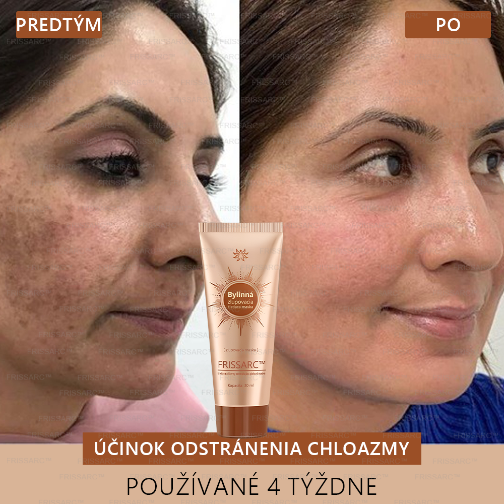 💟FRISSARC™ bieliaca a škvrny odstraňujúca pleťová maska –🍀Prírodné zložky trvalo odstraňujú pigmentové škvrny, starecké škvrny, pehy a slnečné škvrny.