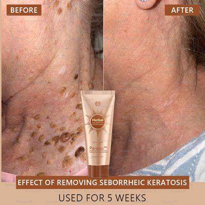 🏵️🏵️ Parowu™ Whitening and Spot-Removing Face Mask Suitable for face and body – 👩‍⚕️ Natural ingredients permanently remove age spots, freckles, sun spots, and liver spots.