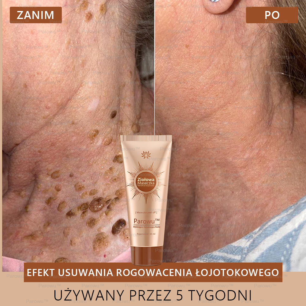💟 Parowu™ Wybielająca i Rozjaśniająca Maska - Naturalne składniki trwale usuwają plamy, piegi i przebarwienia