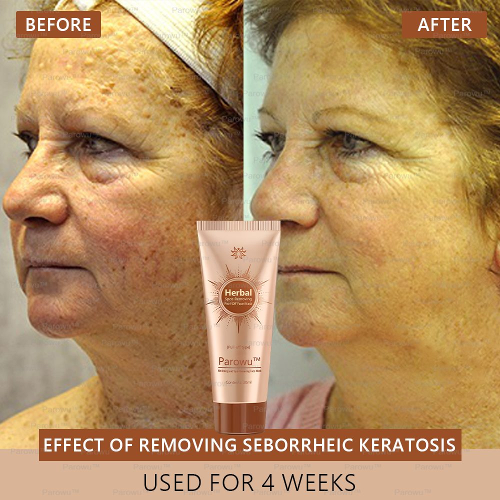 🏵️🏵️ Parowu™ Whitening and Spot-Removing Face Mask Suitable for face and body – 👩‍⚕️ Natural ingredients permanently remove age spots, freckles, sun spots, and liver spots.