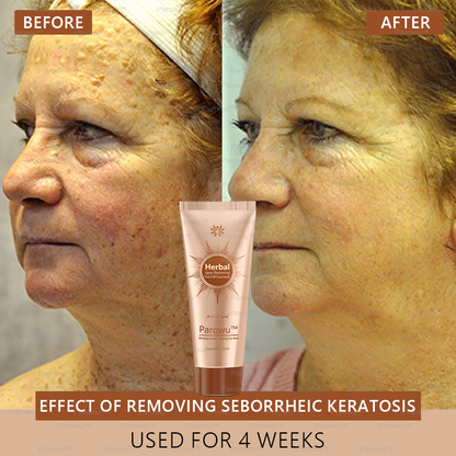 🏵️🏵️ Parowu™ Whitening and Spot-Removing Face Mask Suitable for face and body – 👩‍⚕️ Natural ingredients permanently remove age spots, freckles, sun spots, and liver spots.