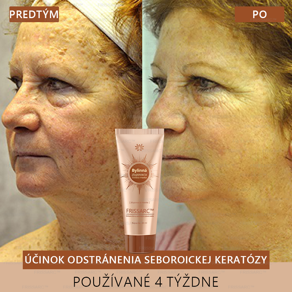💟FRISSARC™ bieliaca a škvrny odstraňujúca pleťová maska –🍀Prírodné zložky trvalo odstraňujú pigmentové škvrny, starecké škvrny, pehy a slnečné škvrny.