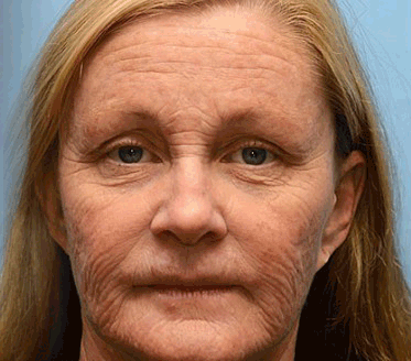 FrissArc™ Botox Méhméreg Ránctalanító Krém ☀️🌙 egész napos bőrápolás!